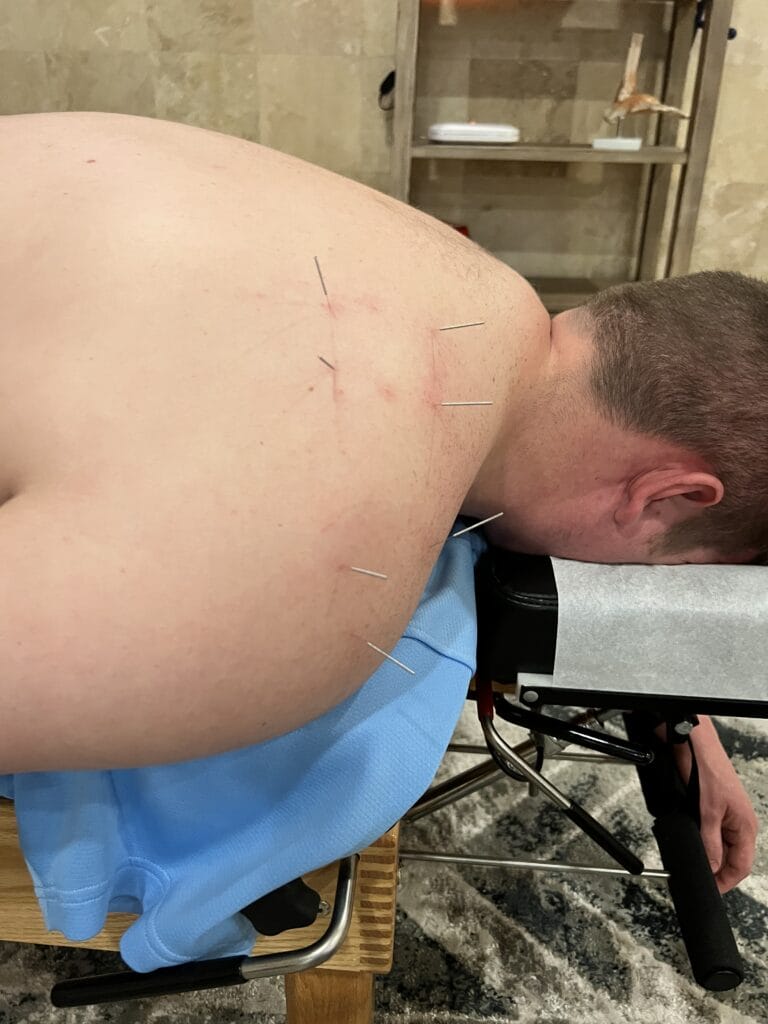 Dry Needling Shouler