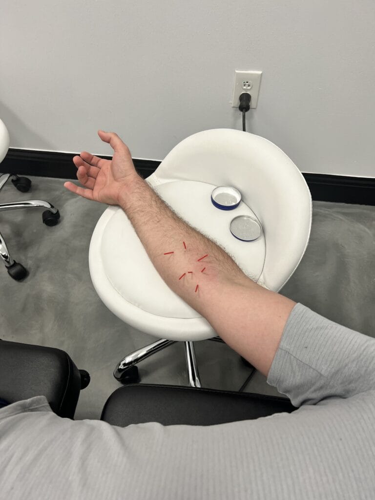 Dry Needling Forearm